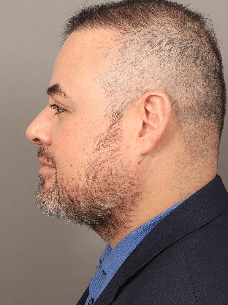 Face Liposuction Before & After