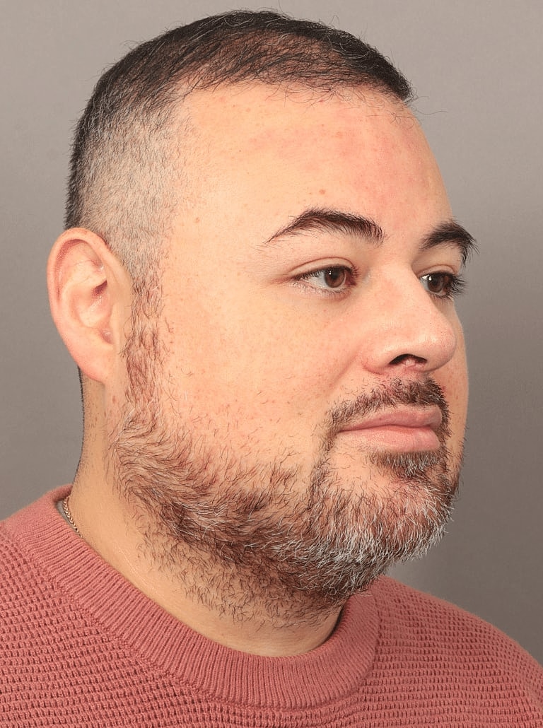 Face Liposuction Before & After