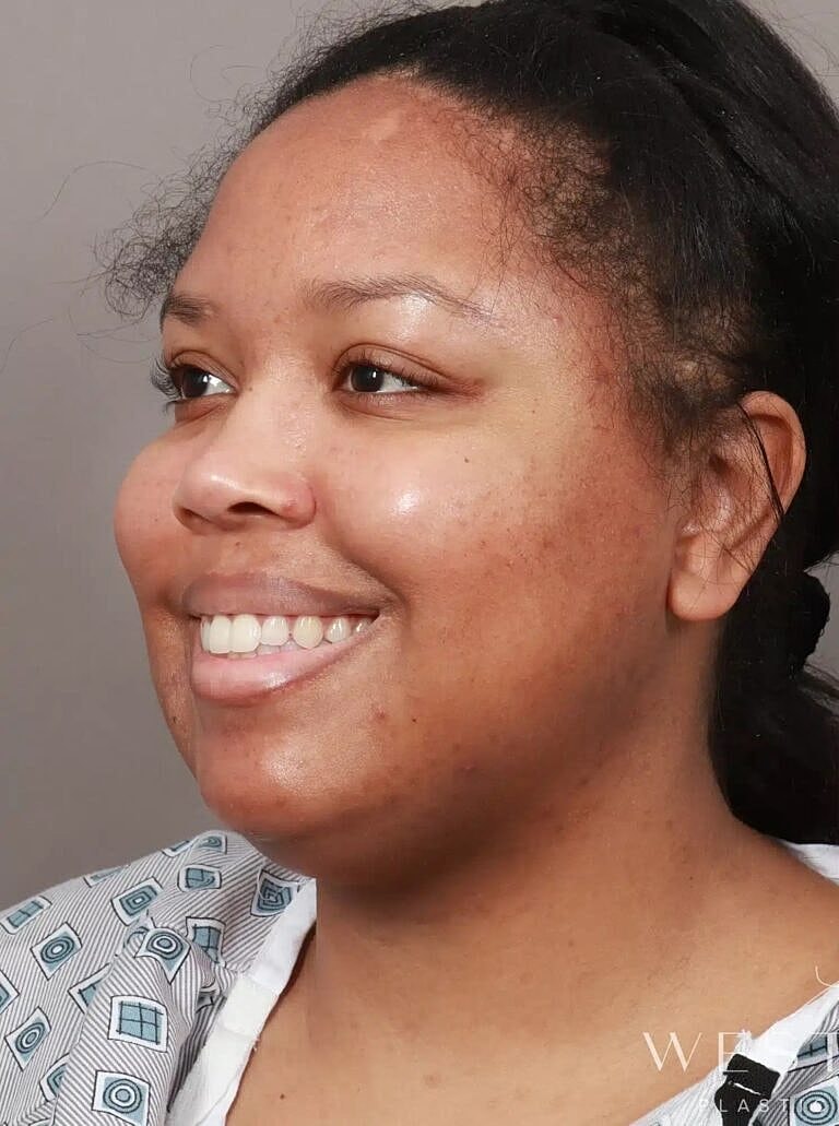 Face Liposuction Before & After