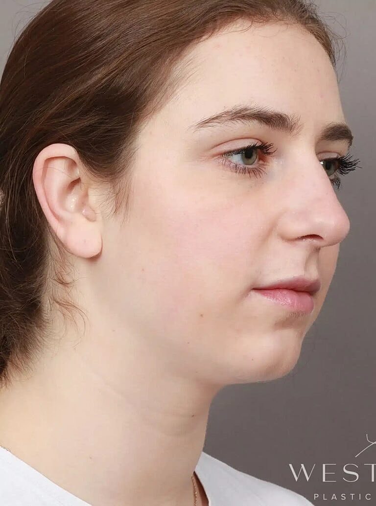 Face Liposuction Before & After