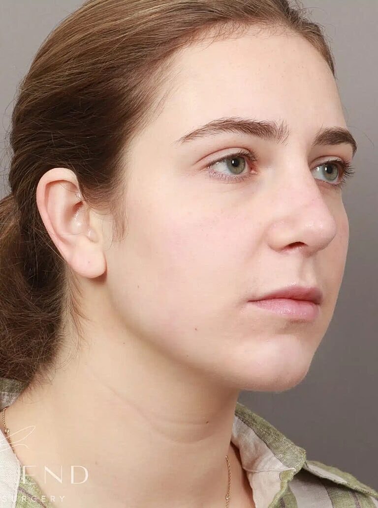 Face Liposuction Before & After