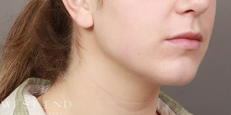 Face Liposuction Before & After