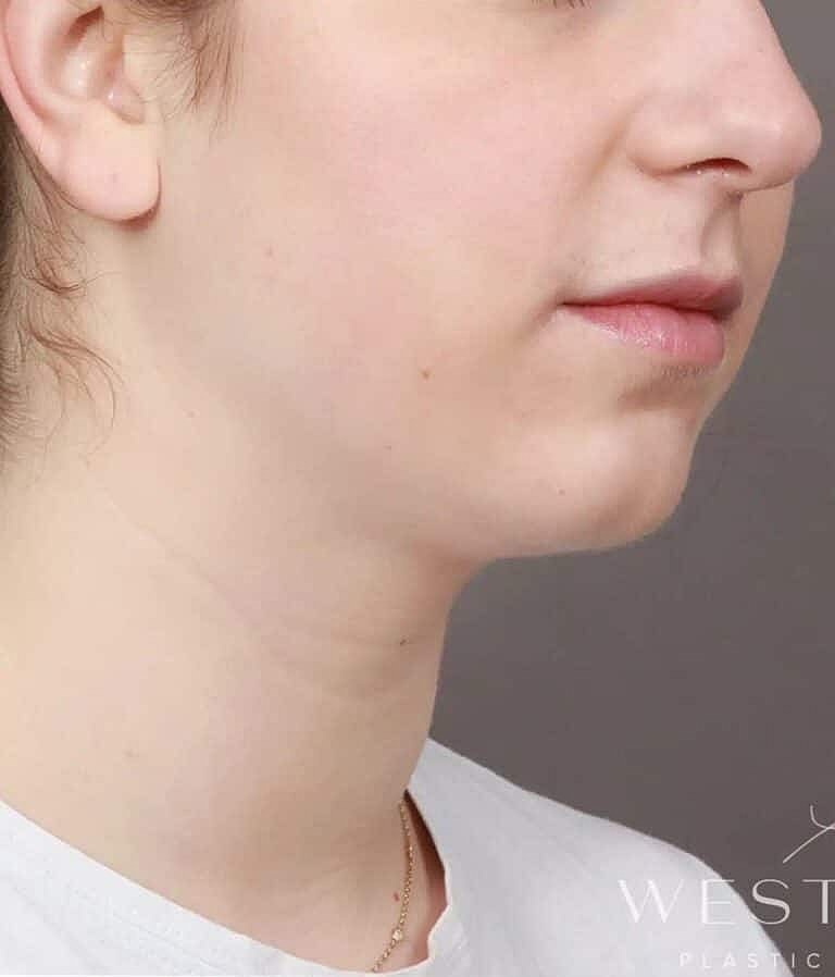 Face Liposuction Before & After