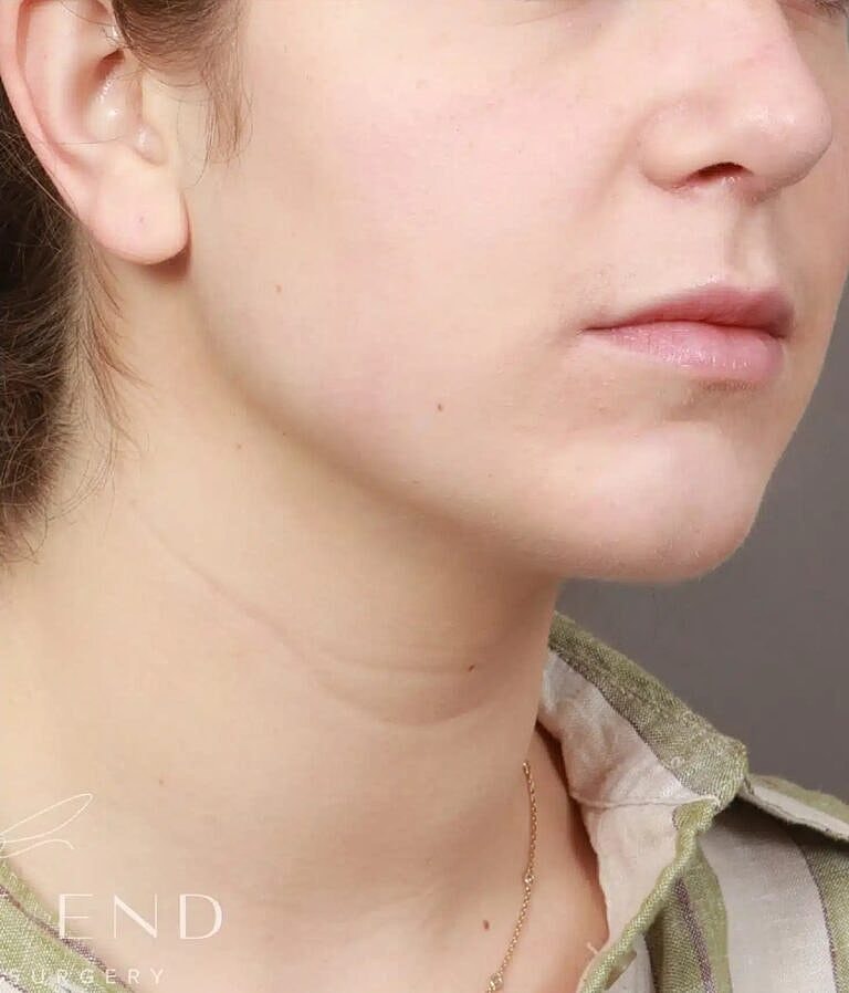 Face Liposuction Before & After