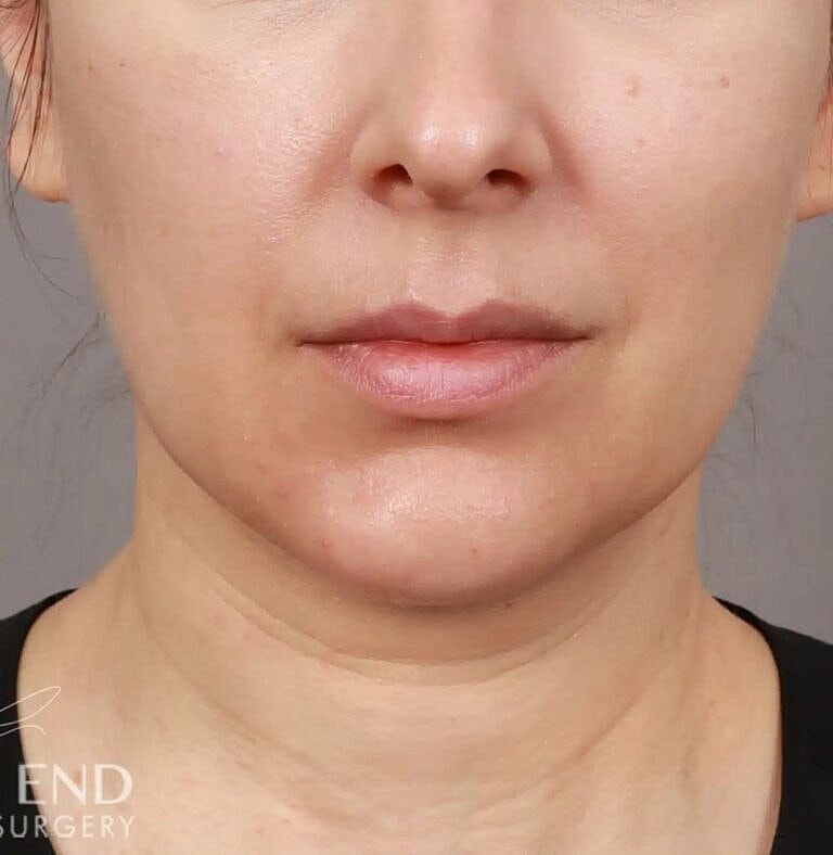 Face Liposuction Before & After