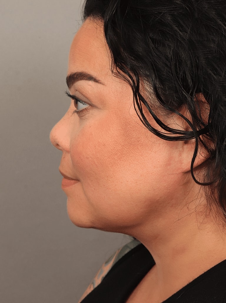Face Liposuction Before & After