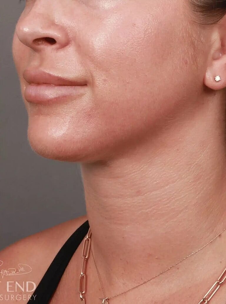 Face Liposuction Before & After