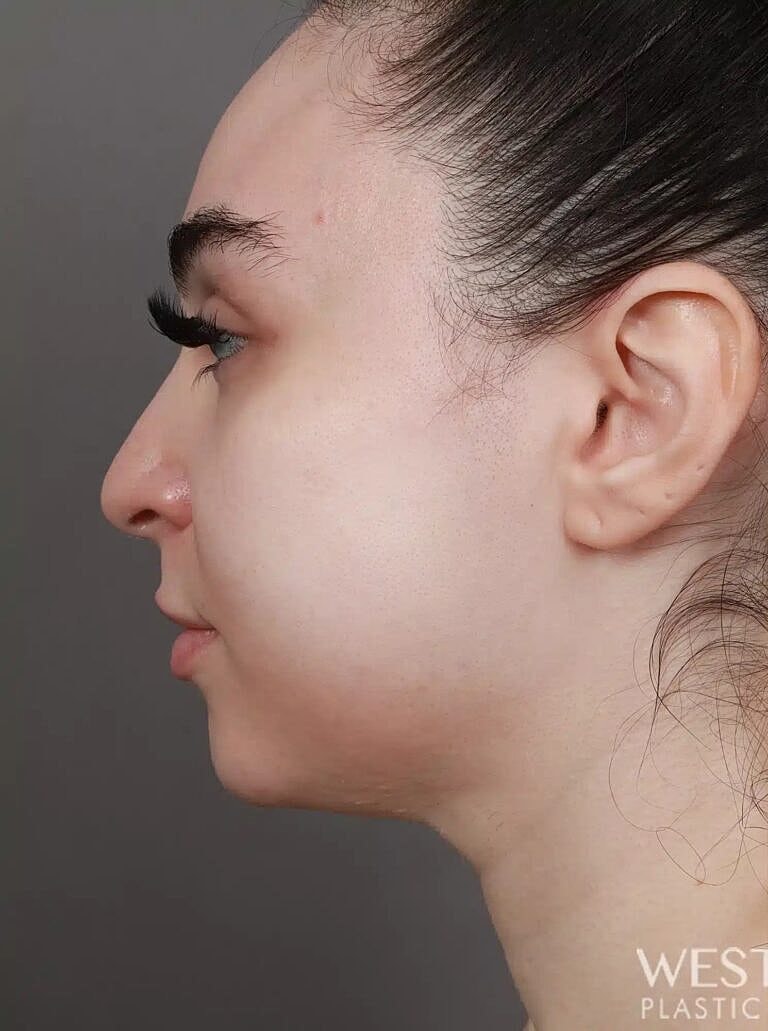 Face Liposuction Before & After