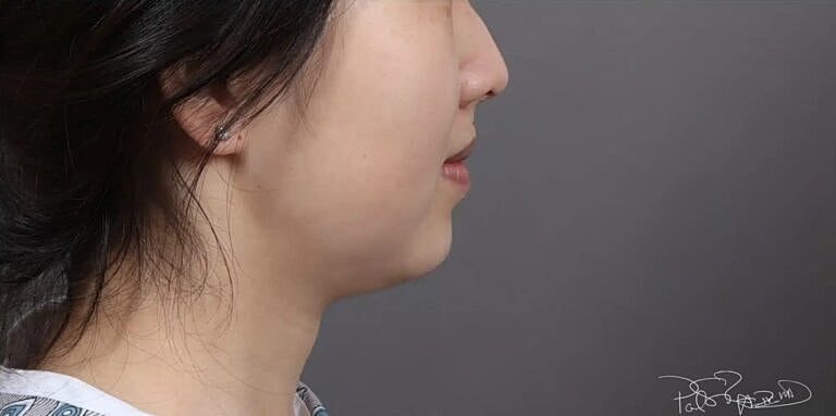 Face Liposuction Before & After