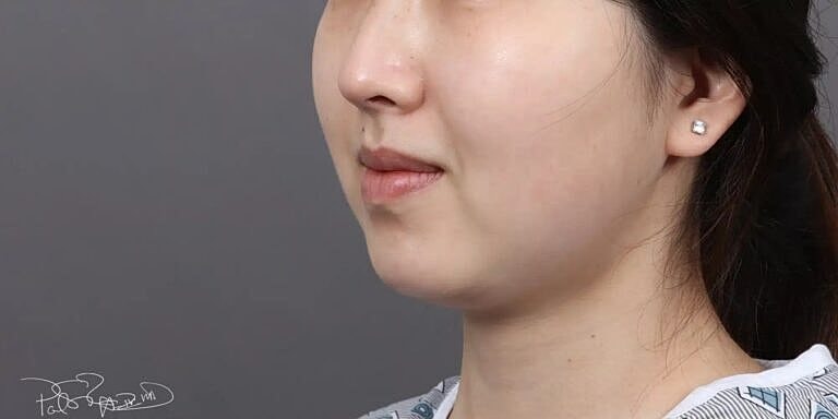 Face Liposuction Before & After
