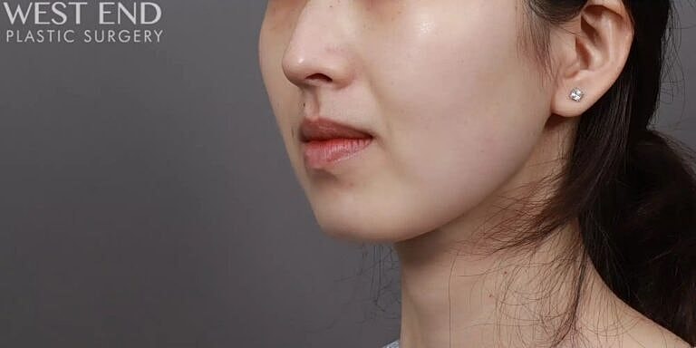Face Liposuction Before & After