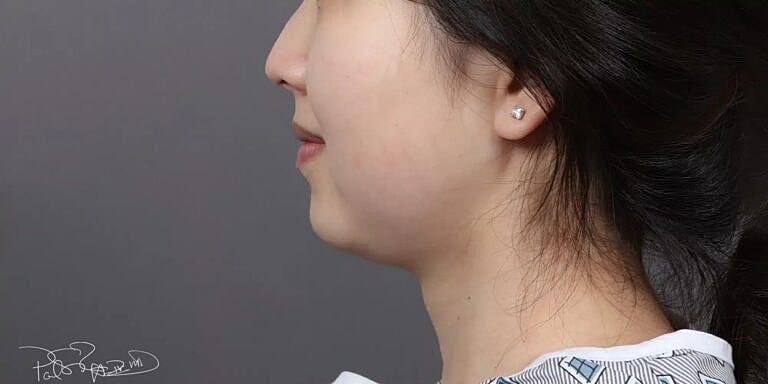 Face Liposuction Before & After