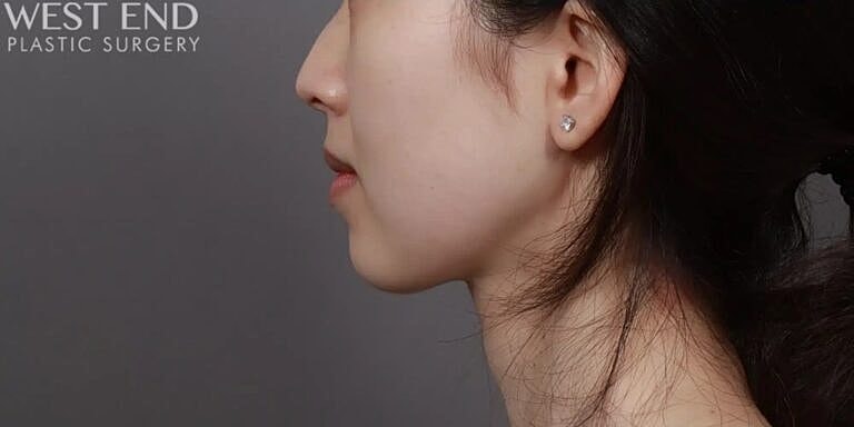 Face Liposuction Before & After