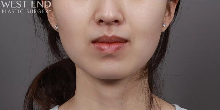 Face Liposuction Before & After