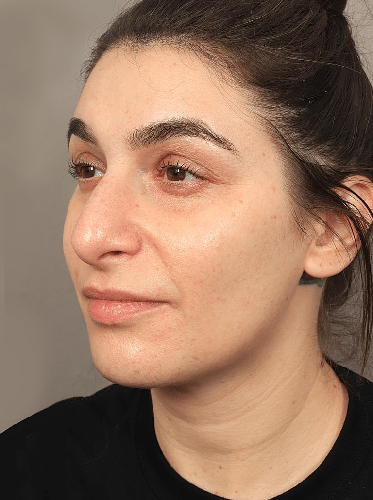 Juvederm Before & After