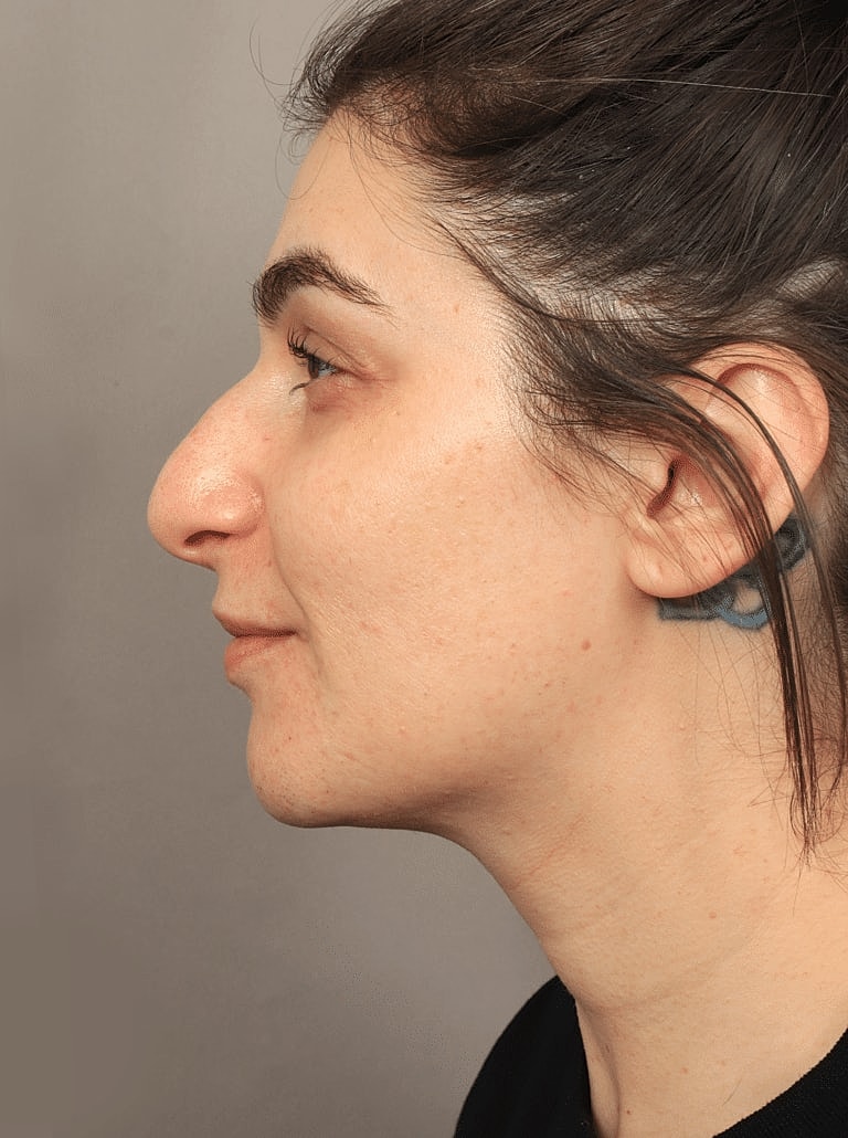 Juvederm Before & After