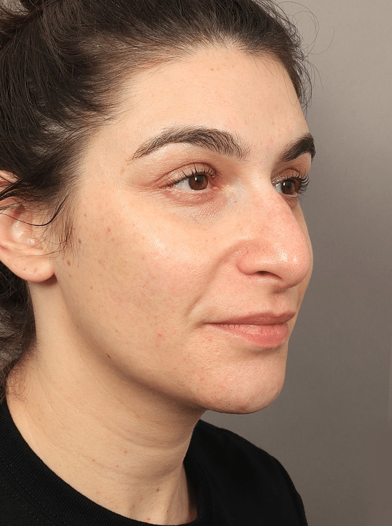 Juvederm Before & After