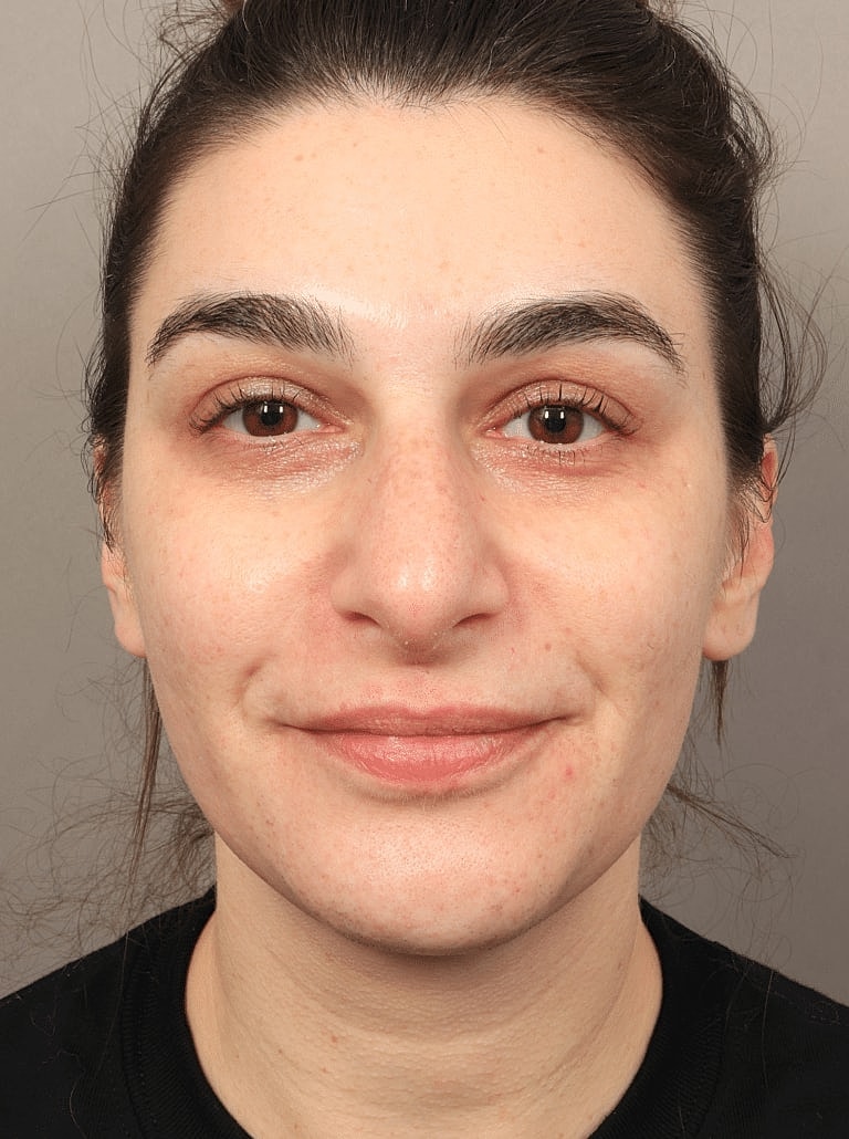 Juvederm Before & After