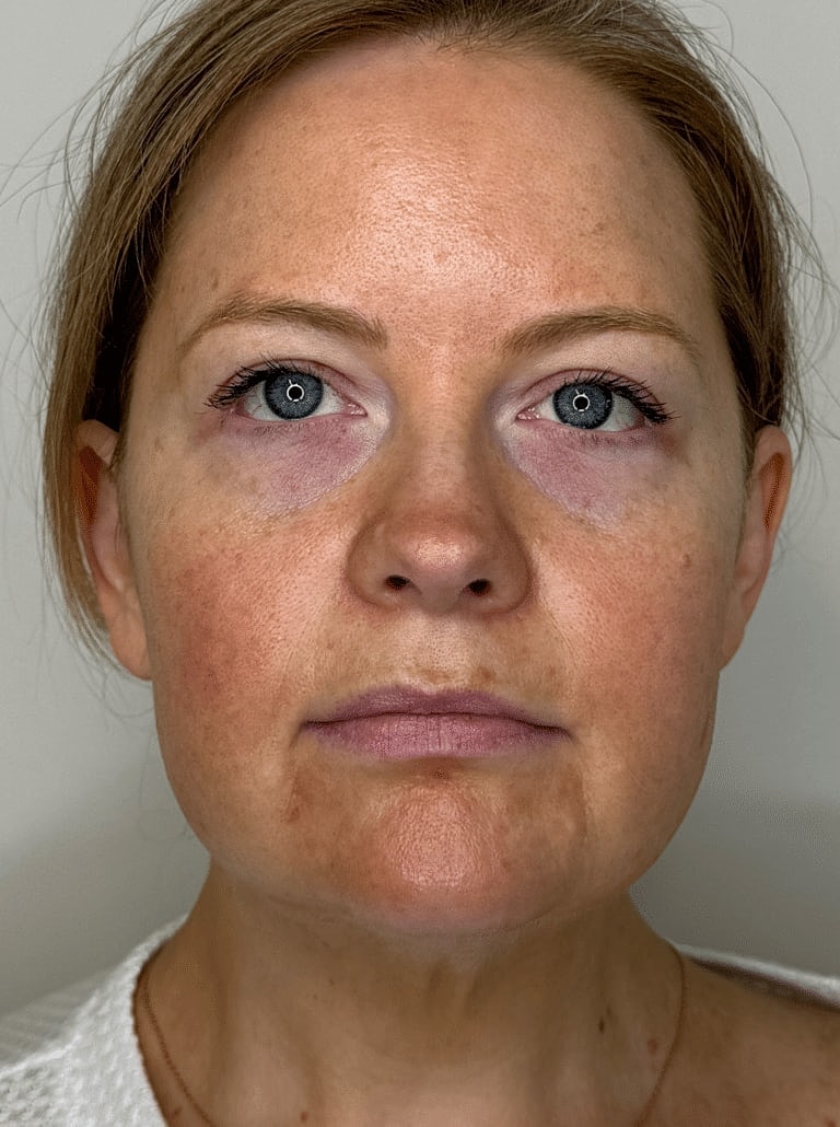 Juvederm Before & After