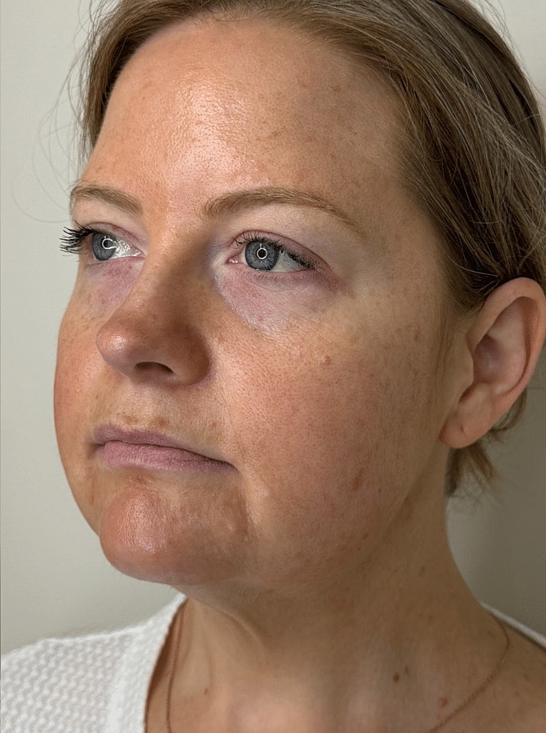 Juvederm Before & After