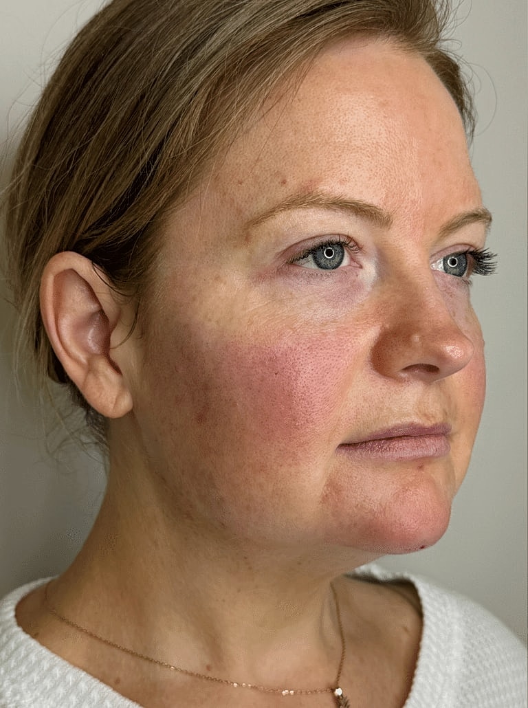 Juvederm Before & After