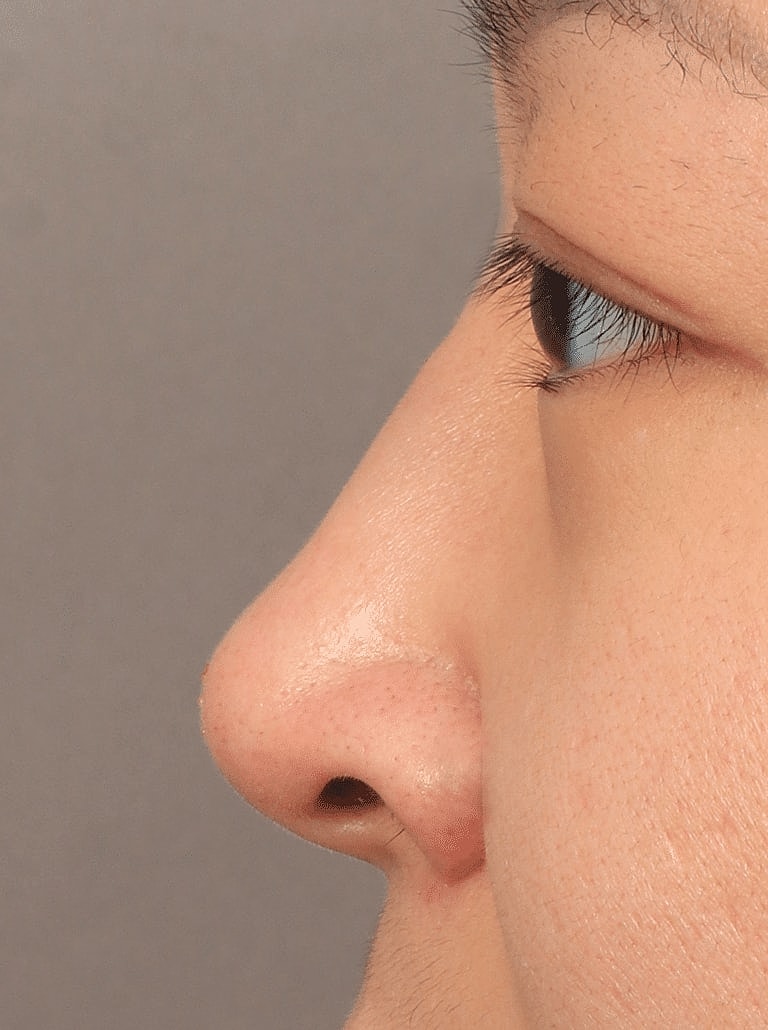 Juvederm Before & After