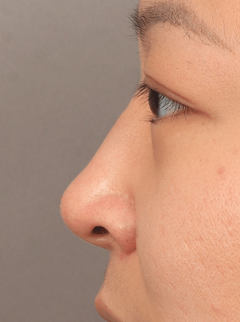 Juvederm Before & After