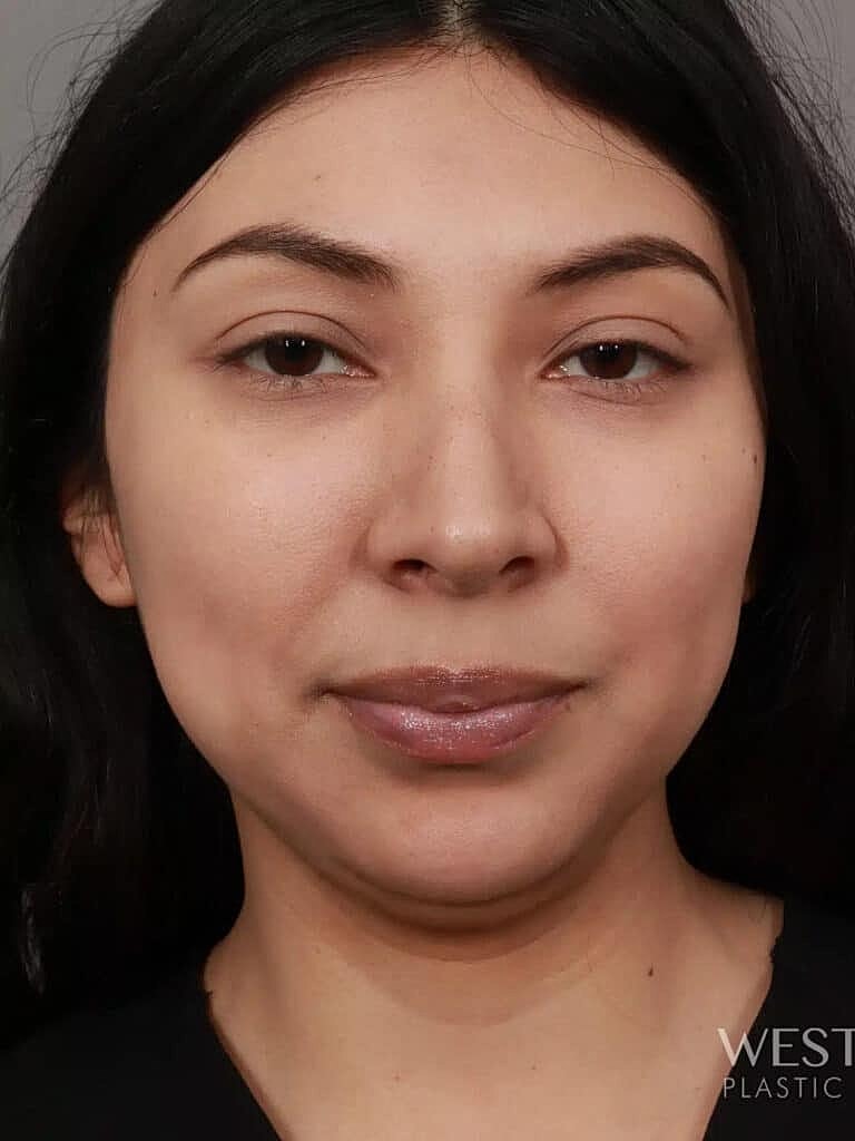 Juvederm Before & After