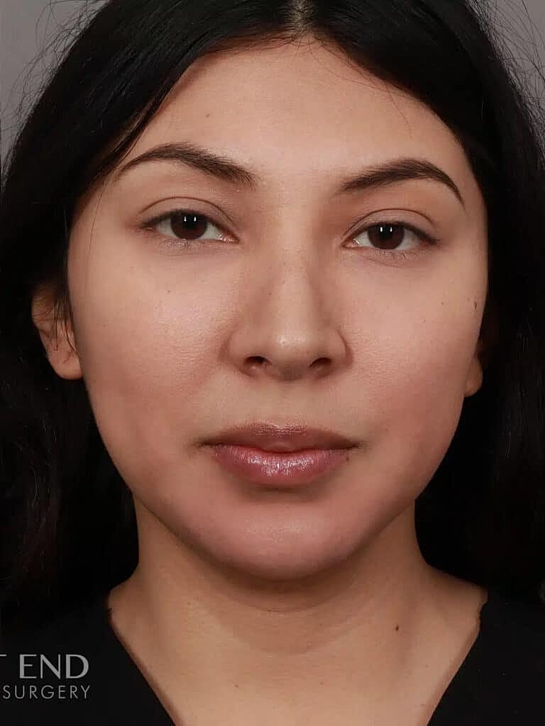 Juvederm Before & After