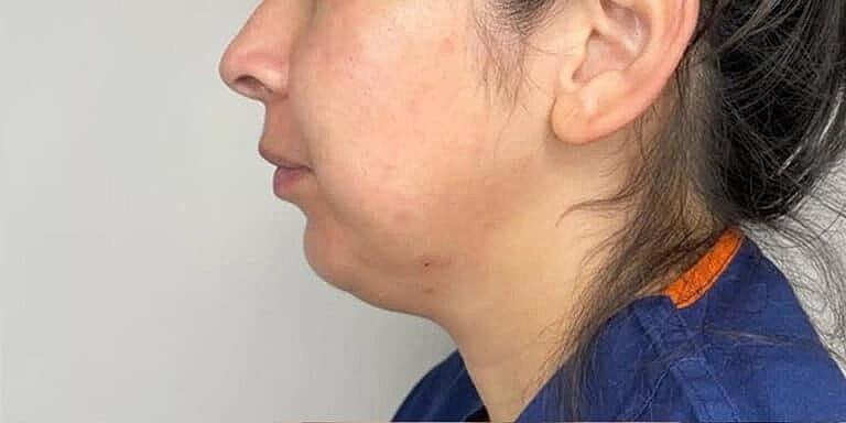Juvederm Before & After