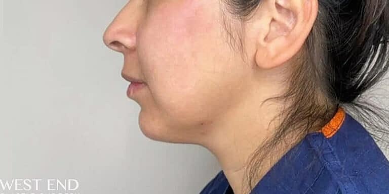 Juvederm Before & After