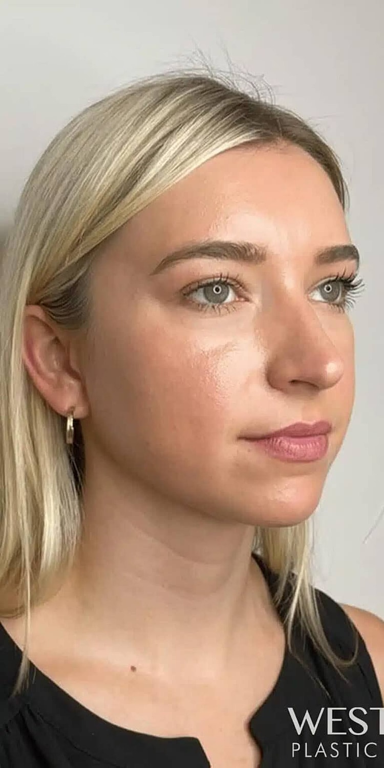 Juvederm Before & After