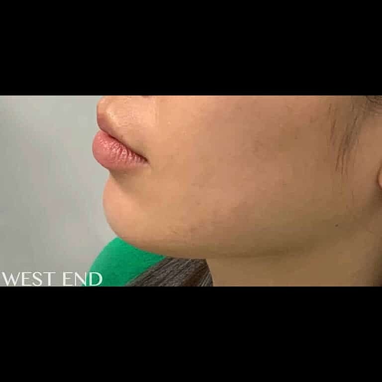 Juvederm Before & After