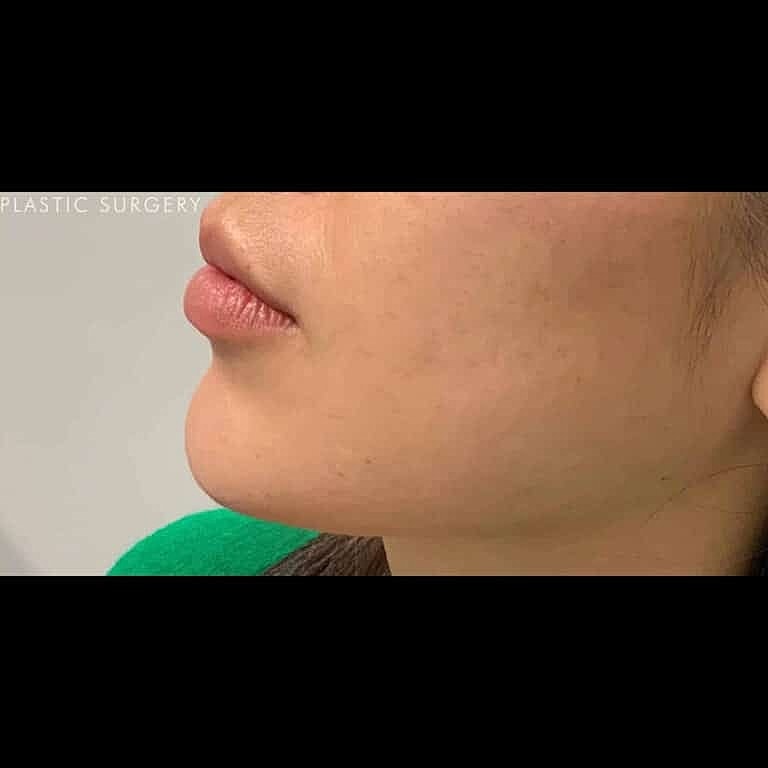 Juvederm Before & After
