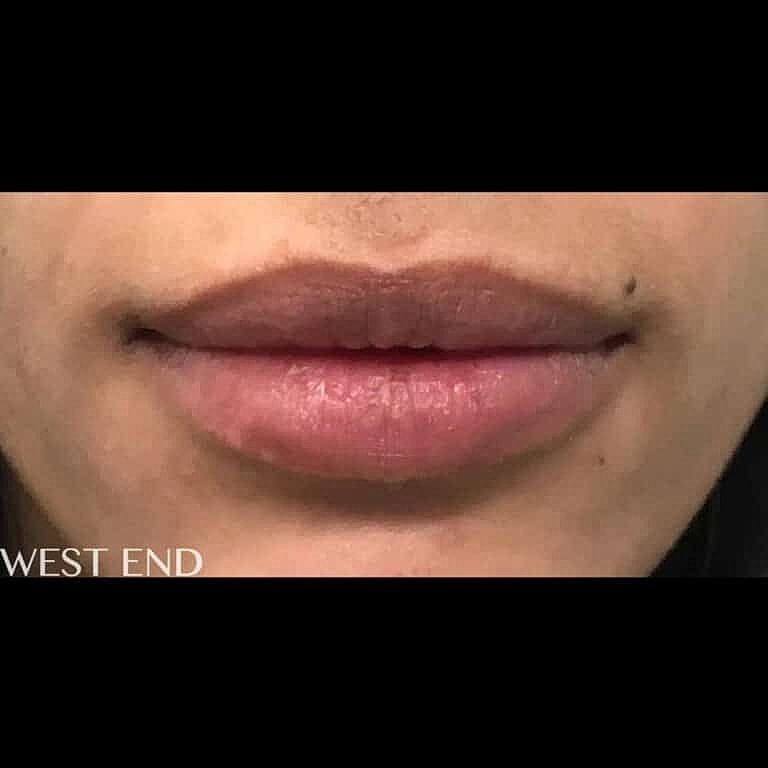 Juvederm Before & After