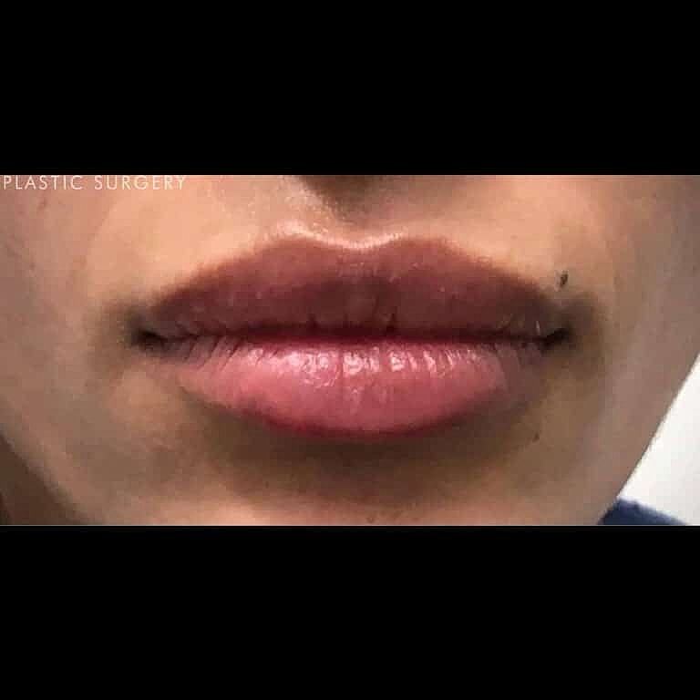 Juvederm Before & After