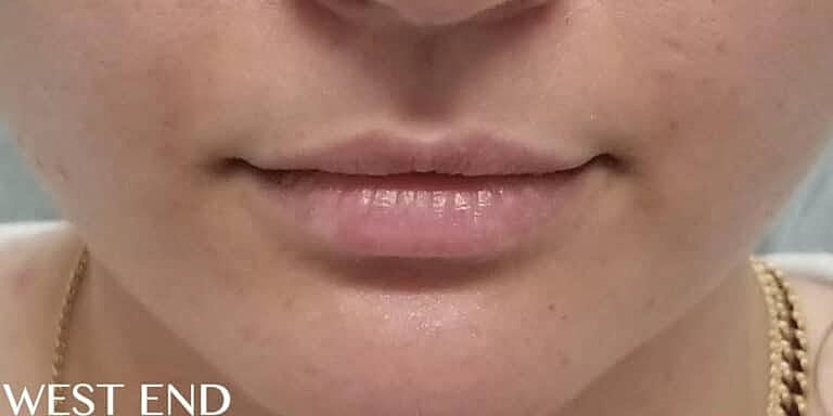 Juvederm Before & After