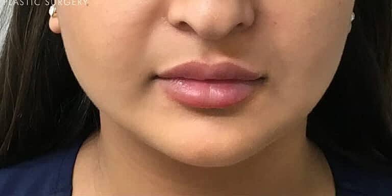 Juvederm Before & After