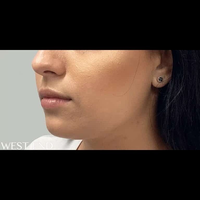 Juvederm Before & After