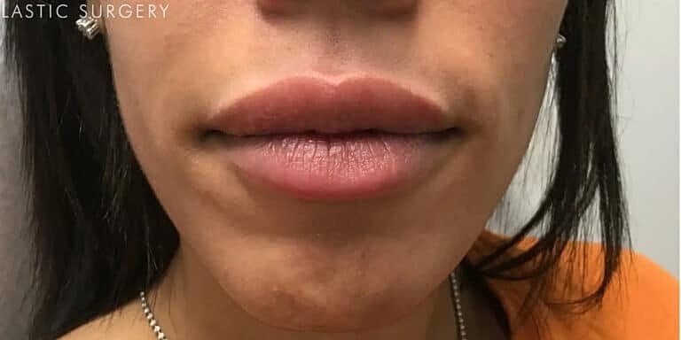 Juvederm Before & After