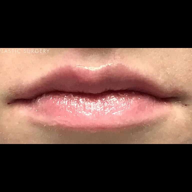 Juvederm Before & After