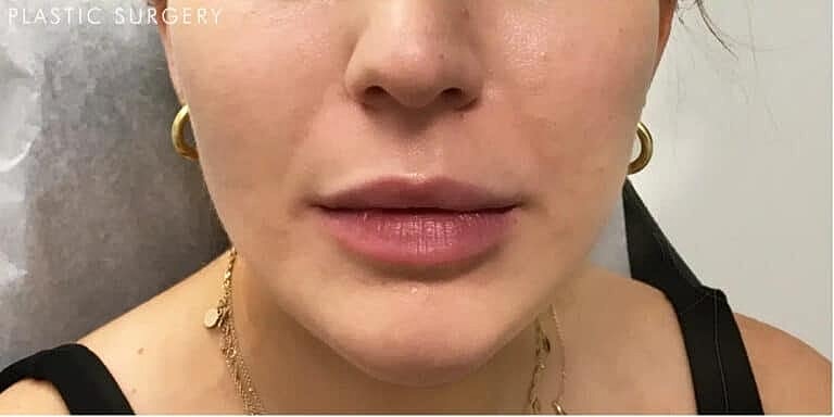 Juvederm Before & After