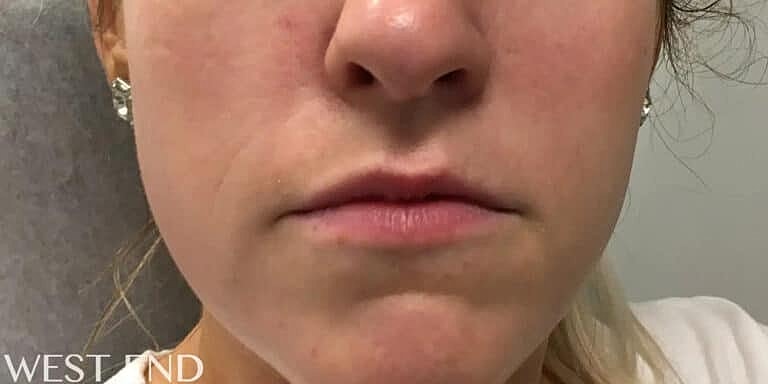 Juvederm Before & After