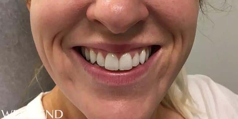 Juvederm Before & After