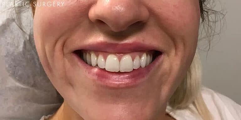 Juvederm Before & After