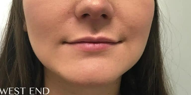 Juvederm Before & After