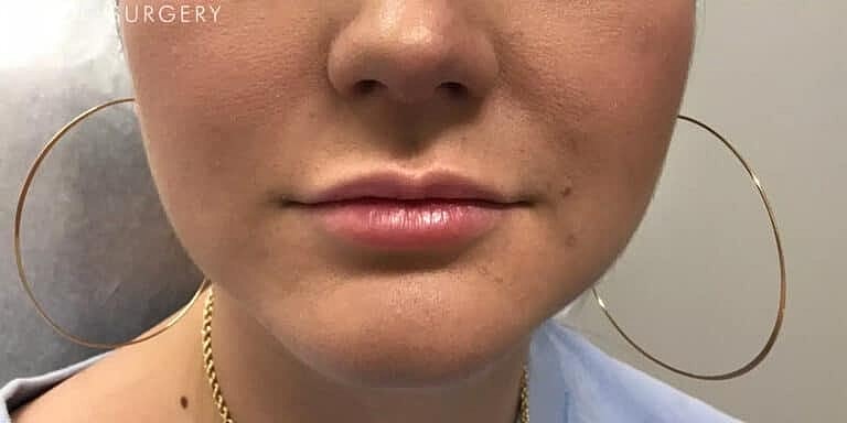 Juvederm Before & After