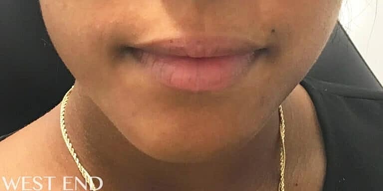 Juvederm Before & After