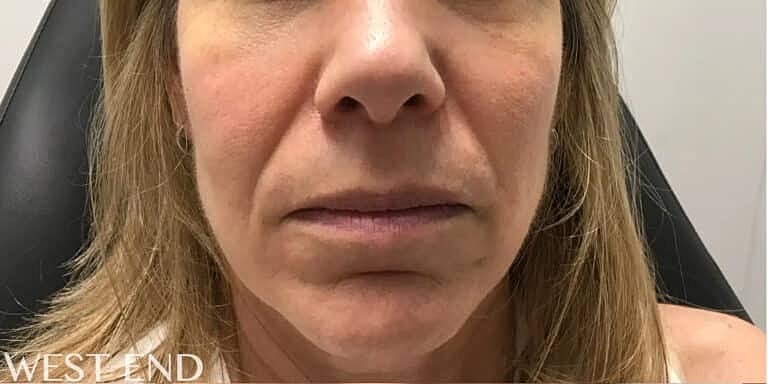 Juvederm Before & After