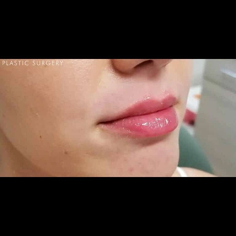 Juvederm Before & After